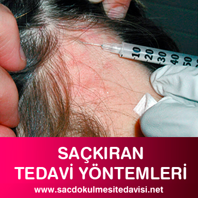 Alopesi areata steroid tedavisi